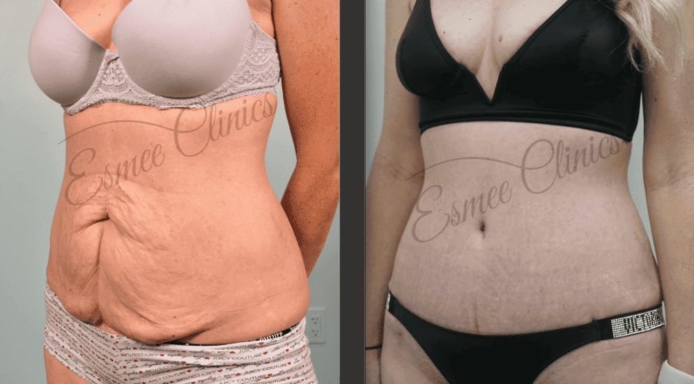 Before and After img